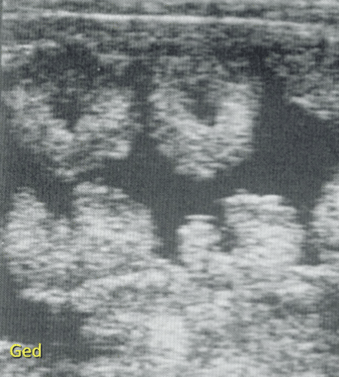 <p>Billedet viser et ultralydsbillede taget ved transabdominal scanning af en ged i forbindelse med en drægtighedsundersøgelse:</p><p>- Geden har tilbageholdt efterbyrd</p><p>- Geden er drægtig</p><p>- Geden har hydrometra</p><p>- Geden er ikke drægtig</p>