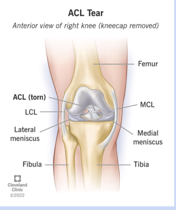 <p>(ACL tear) - causes instability of knee</p><p>includes surgical repair and then post op therapy</p>