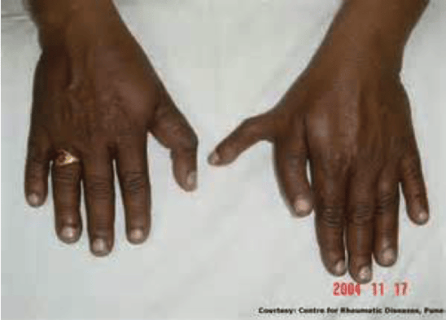 <p>duplication of the thumb(s) or of the halux (great toe)</p>