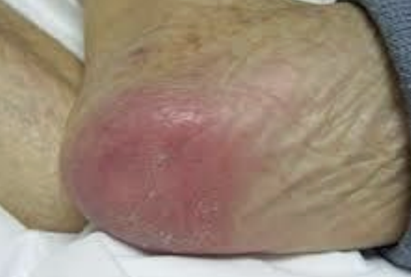 <p>pressure injury stage</p>