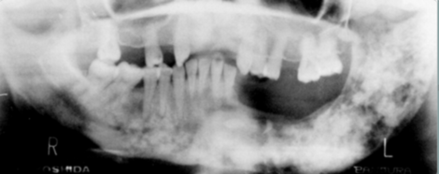 <p>mixed</p><p>ill-defined</p><p>increased sclerotic bone</p><p><strong>does not cross midline</strong></p><p>shortening root</p>