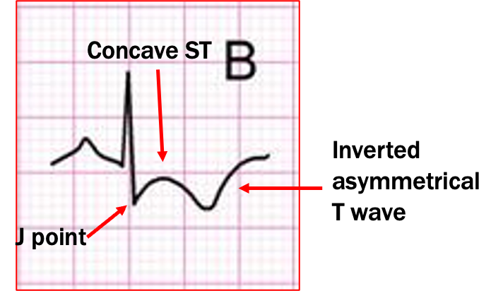 <p>R:S ratio 1mm or more in V1-V2 (more R than S)</p><p>supportive:</p><ul><li><p>RAE</p></li><li><p>RAD</p></li><li><p>strain pattern- concave ST set turning into inverted asymmetrical T wave in V1-V2</p></li></ul><p>exclusionary: RBBB, posterior wall MI, children < 8</p>