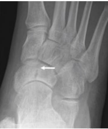 <p>Navicular Stress Fracture</p>