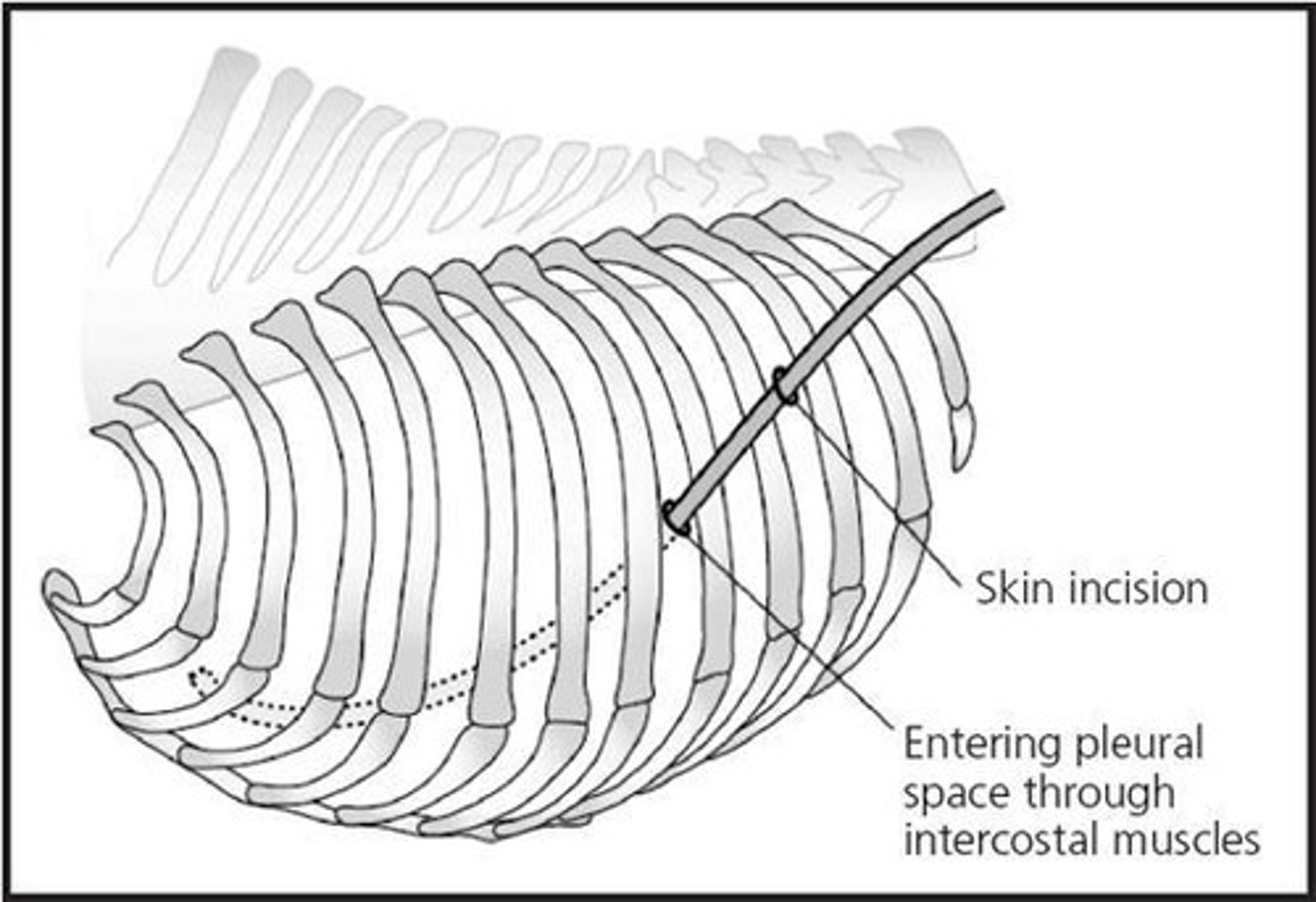 <p>Place a thoracostomy tube through an intercostal space one to two spaces caudal to the incision prior to closing the thorax.</p>