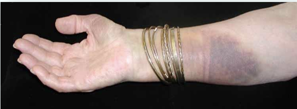 <p>COLLECTION OF BLOOD IN THE SUBCUTANEOUS TISSUES CAUSING PURPLISH DISCOLORATION.</p>