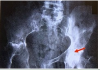 <p>A 68 yo man presents to his physician's office with diffuse pelvic pain. XR of the abdomen for this patient is shown right. Which of the following would help to diagnose the primary tumor most commonly responsible for these radiologic findings?</p><p class="p1">a. Digital rectal examination</p><p class="p1">b. Palpation of the abdomen</p><p class="p1">c. Palpation of costovertebral angle</p><p class="p1">d. Palpation of the neck</p><p class="p1">e. Skin examination</p>