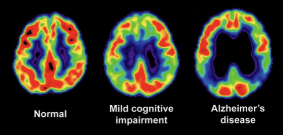 <p>It shows where a radioactive form of glucose goes while the brain performs a given task (visual display of this brain activity) —&gt; radioactive isotope decays into a nonradioactive atom after a minute</p>