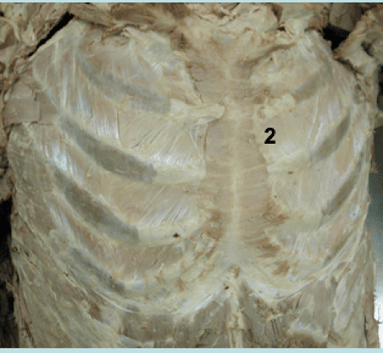 <p>2nd intercostal space, L sternal border</p>