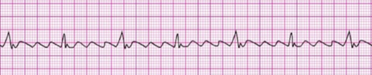 <p>Atrial Flutter</p>