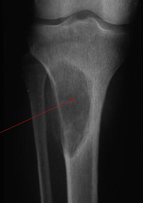 <p>What are radiographic signs of Hyperparathyroidism?</p>
