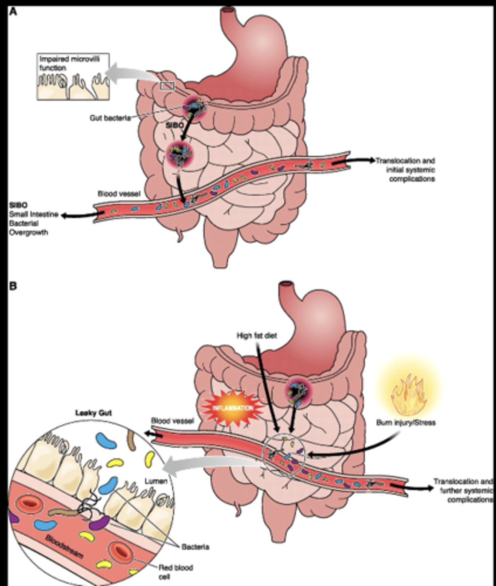 <p>External injury (e.g., burn injury, HFD, alcohol intake) results in gut microbiota translocation due to a "leaky gut"</p><p>Endotoxemia promote further systemic complications and damage to remote organ systems</p>