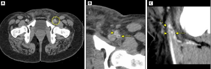 <p><strong>Arterial Embolism/Thrombosis Diagnosis and Management: </strong></p><p>Diagnosis</p><p>-Usually ________, take a good history and exam</p><p>-Bedside arterial doppler</p><p>-CT ___________, as long as it won’t impede treatment</p><p></p><p>Management</p><p>-Unfractionated ________ + __ Heparin Infusion</p><p>-Pain control</p><p>-IV Fluids</p><p>-____________ is the mainstay of treatment, consult ________ team </p>