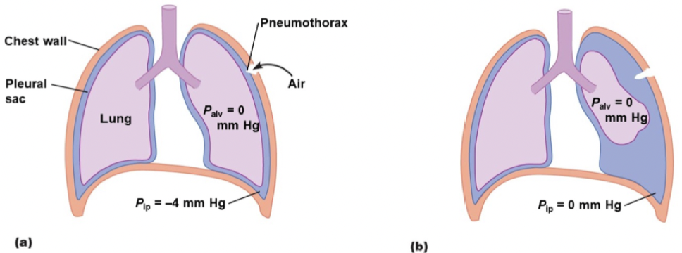 <p>Lung collapse. Occurs when the pleural sac is punctured. The negative pressure is filled with air and the connection between lung and chest wall no longer exists, so the lung pulls away from chest wall</p><p></p><p>Each lung is separate in this case; only one can collapse and the other can be fine because lungs are individually wrapped in their own pleural sac.</p>