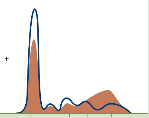 <p>Decreased albumin production<br>Classic beta-gamma bridge due to immunoglobulin subclasses</p>