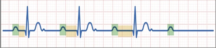 <ul><li><p class=""><strong>PR Interval</strong>: <strong><em><mark data-color="yellow" style="background-color: yellow; color: inherit"><u>Steady lengthening</u></mark></em></strong> (slowly gets further from the QRS complex until the QRS complex disappears).</p></li><li><p class=""><strong>QRS Complex</strong>: Dropped or blocked.</p></li><li><p class=""><strong>PP Interval</strong>: Regular.</p></li><li><p class=""><strong>RR Interval</strong>: Irregular.</p></li><li><p class=""><strong>QRS</strong>: Normal.</p></li><li><p class="">Decreased cardiac output may occur.</p></li></ul><p class=""><strong>Treatment</strong>: If <strong>symptomatic</strong>, treat with <strong>atropine</strong>.</p><p></p>