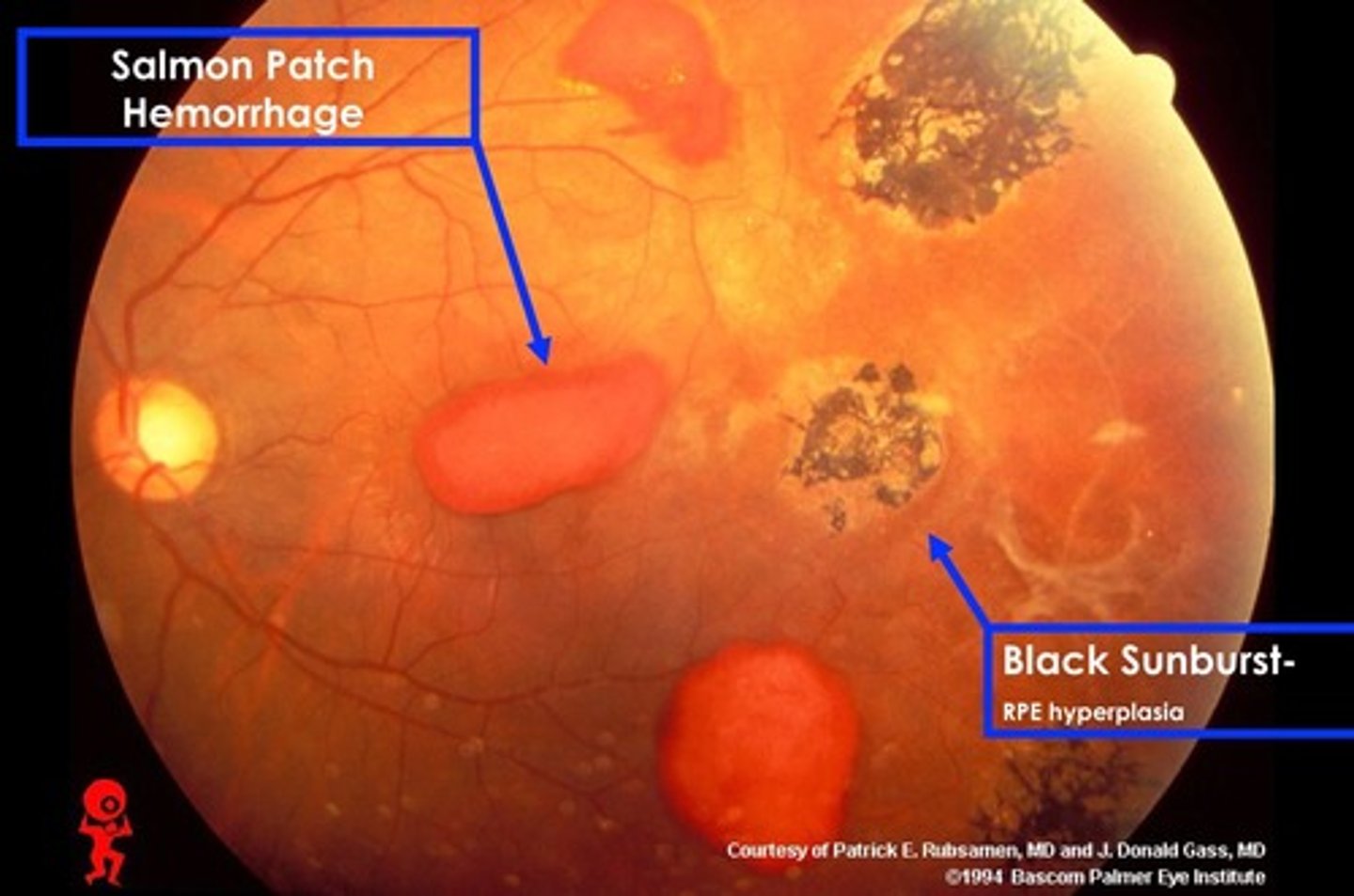 <p>d. sickle cell retinopathy</p><p>all start with "S"</p>