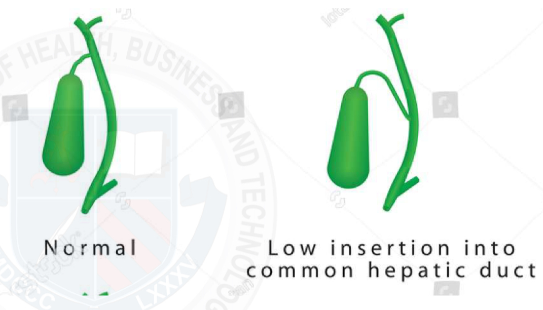 <p><span style="color: rgb(203, 213, 225)">Normal common bile duct has a diameter of up to 6 mm&nbsp;</span></p><p>Length variation&nbsp;</p><p>- CD and CHD may join more distally&nbsp;</p><p>- CBD will be shorter&nbsp;</p>