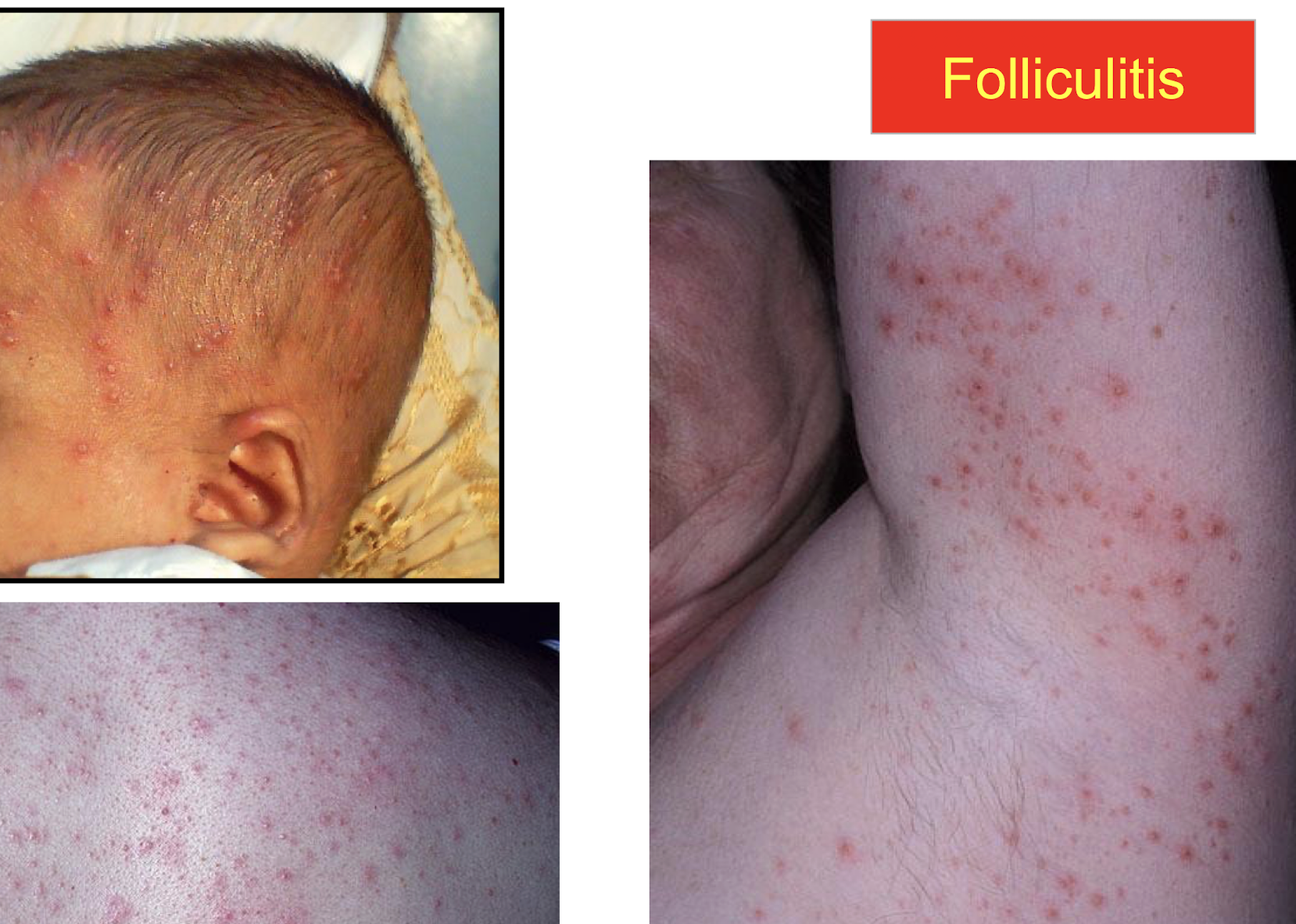 <p>infection of the hair follicles, deep-seated infection in and around a hair follicle that forms a painful nodule or abscess. </p><img src="https://knowt-user-attachments.s3.amazonaws.com/0f0711d0-54ff-43c1-837d-af39b630a943.png" data-width="100%" data-align="center"><p></p>