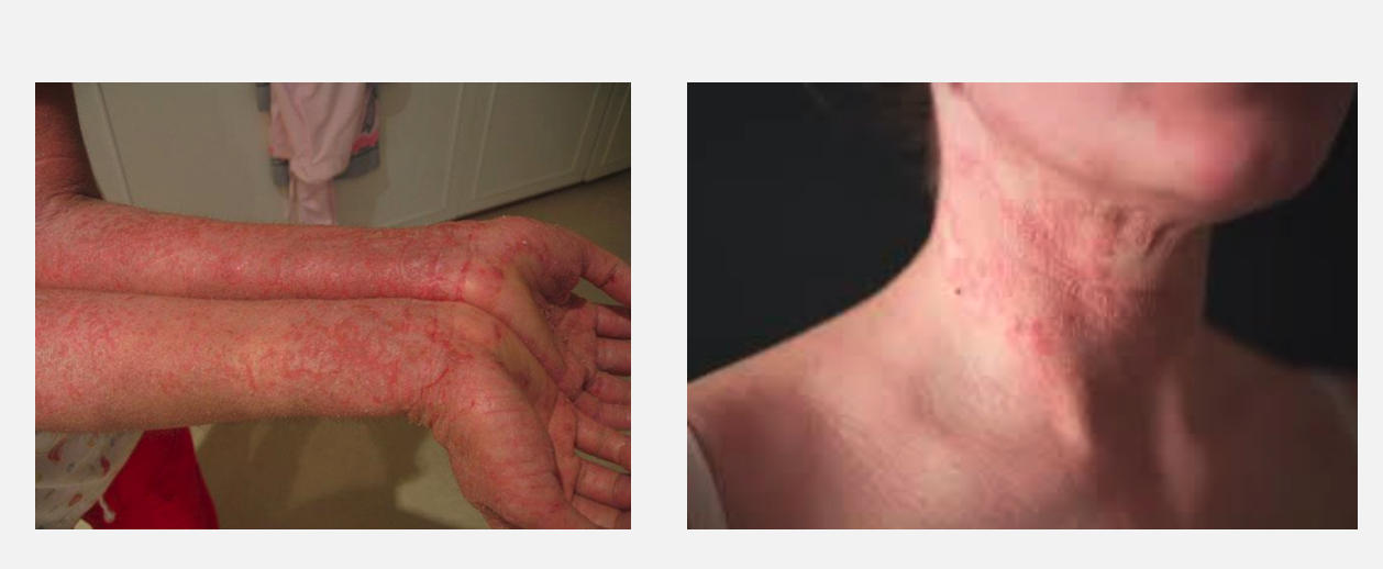 <ul><li><p><strong>Infants: Widely distributed—></strong> Extensor surfaces (wrists, elbows, ankles, knees).</p></li><li><p><strong>Adults:</strong> Flexural surfaces (antecubital and popliteal fossae).</p></li></ul><p></p>