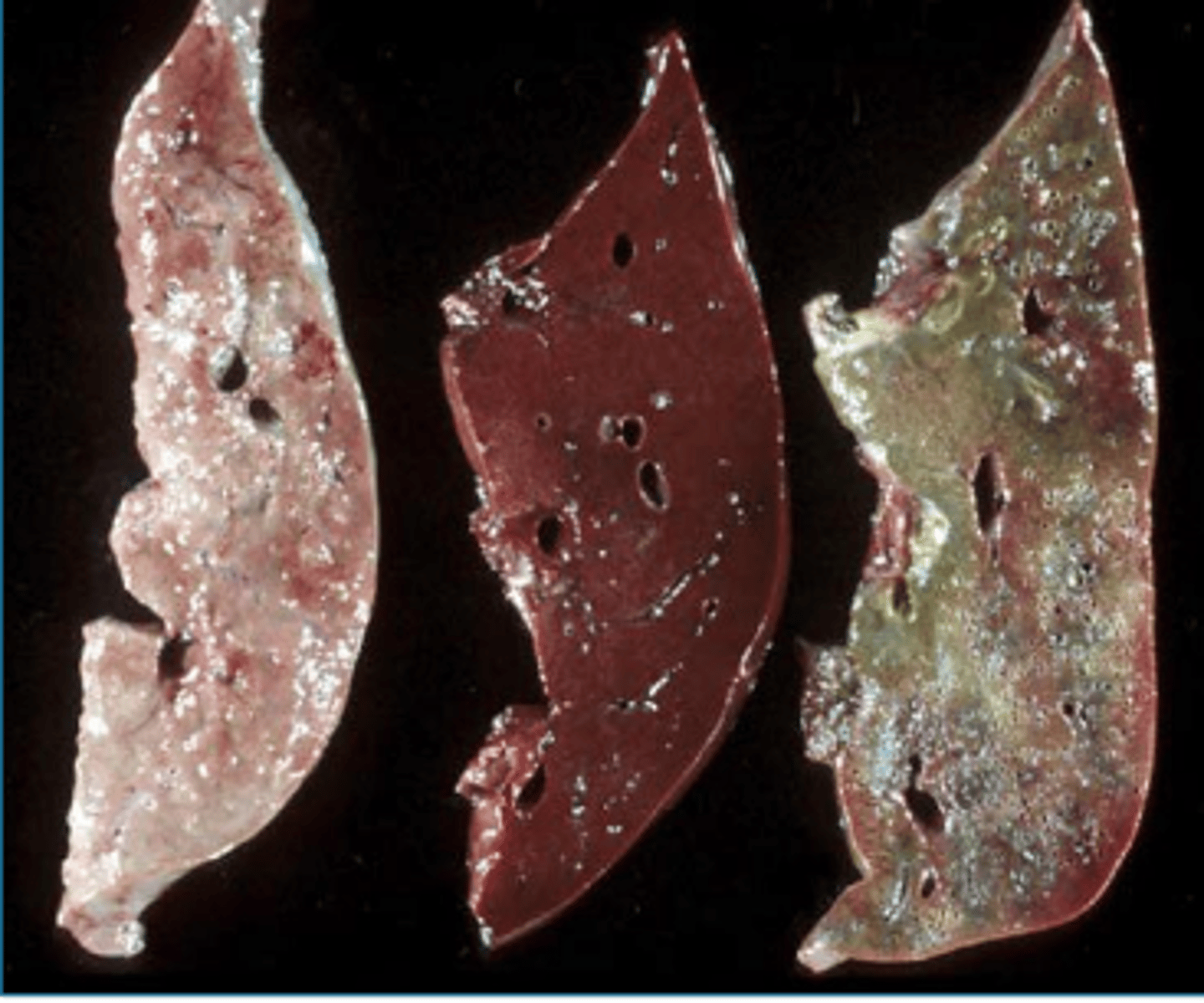 <p>what is the pigment in the gall bladder on the far right?</p>