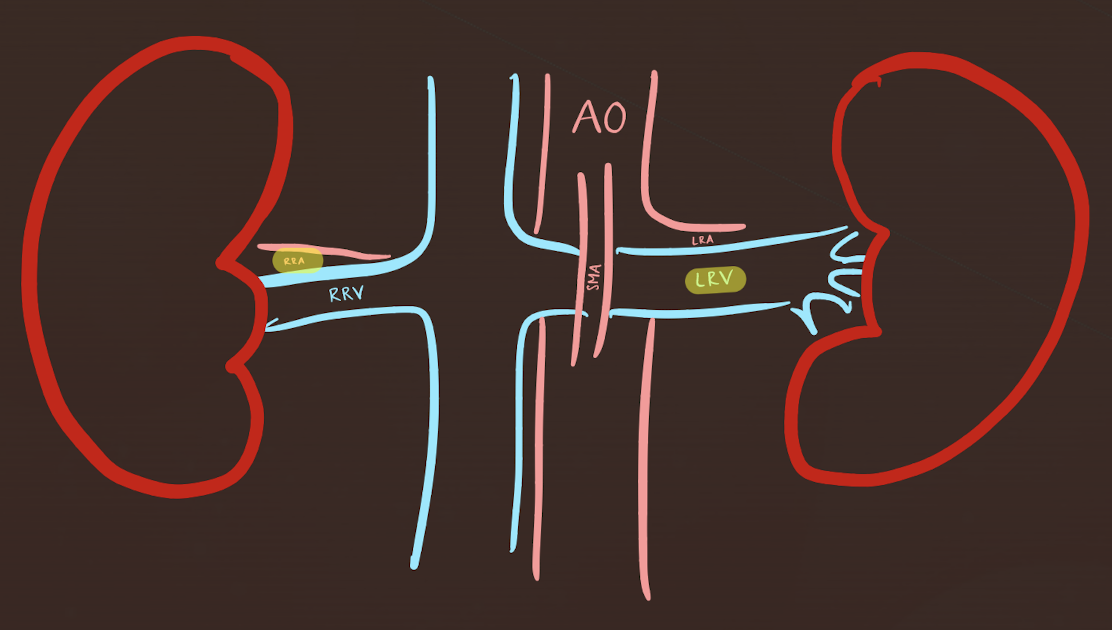 <p>LRV</p><ul><li><p><mark data-color="yellow" style="background-color: yellow; color: inherit;">anterior to AO</mark>; <mark data-color="yellow" style="background-color: yellow; color: inherit;">posterior to SMA</mark></p></li><li><p>runs from left kidney to IVC</p></li></ul><p>RRA</p><ul><li><p><mark data-color="yellow" style="background-color: yellow; color: inherit;">posterior to IVC </mark>(<em>excuse me)</em></p></li><li><p>runs from AO to RK</p></li></ul><p></p>