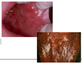 <p><span style="background-color: transparent; font-family: "Times New Roman", serif;">*More common in <strong>elderly</strong></span></p><p><span style="background-color: transparent; font-family: "Times New Roman", serif;">*Fatigue, weakness, lightheadedness</span></p><p><span style="background-color: transparent; font-family: "Times New Roman", serif;">*<strong>Paresthesia, tingling, numbness of extremities</strong></span></p><p><span style="background-color: transparent; font-family: "Times New Roman", serif;">*Atrophy of gastric mucosa</span></p><p><span style="background-color: transparent; font-family: "Times New Roman", serif;">*<strong>Increased risk of gastric carcinoma</strong> (1-2%)</span><br></p><p><span style="background-color: transparent; font-family: "Times New Roman", serif;">ORAL:</span></p><p><span style="background-color: transparent; font-family: "Times New Roman", serif;"><strong>*Burning sensation of tongue, lips, buccal mucosa</strong></span></p><p><span style="background-color: transparent; font-family: "Times New Roman", serif;"><strong>*Oral mucosal atrophy and erythema</strong></span></p><p><span style="background-color: transparent; font-family: "Times New Roman", serif;"><strong>*Atrophic glossitis</strong></span></p><p><span style="background-color: transparent; font-family: "Times New Roman", serif;"><strong>*”Beefy red tongue”</strong></span></p><p><span style="background-color: transparent; font-family: "Times New Roman", serif;"><strong>*Yellow-tinged mucosa</strong></span></p>