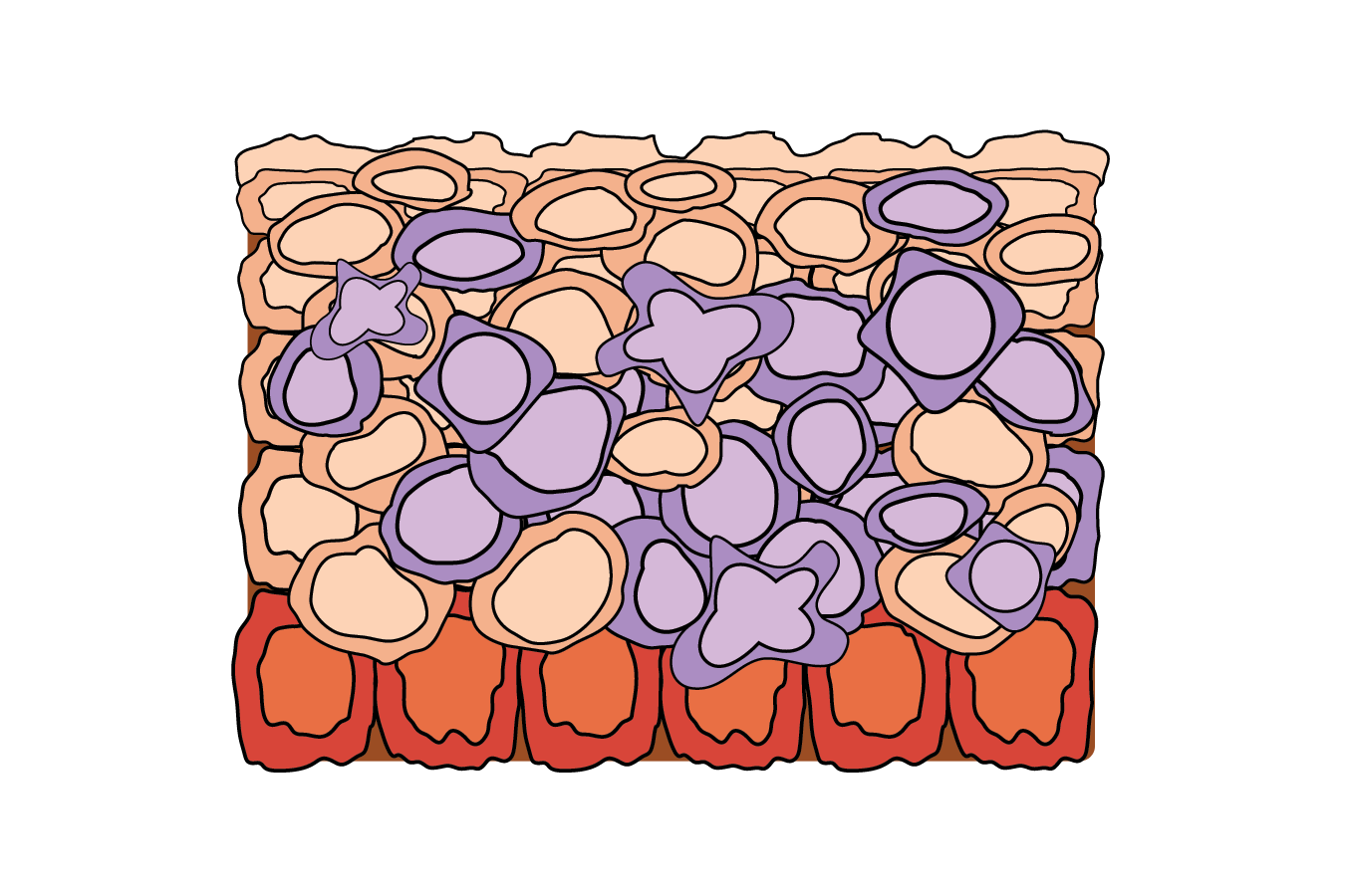 <p><span>Carcinoma in situ/Severe dysplasia. The tissue shows uncontrolled growth of cells and abnormal tissue arrangement and cell structure. However, the abnormalities remain within the original location.</span></p>