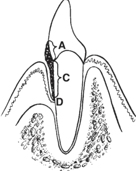 <p>Calculus Detection: <strong>Sub</strong>gingival</p>