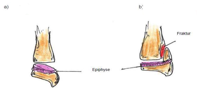 <p>Epiphysen(Wachtumszonen)fraktuen nach Aitken - körperferne Tibia (Schienbein)</p>