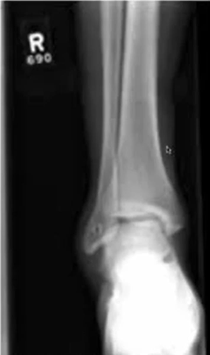 <p>this is a right ankle facing you in anatomical position</p>