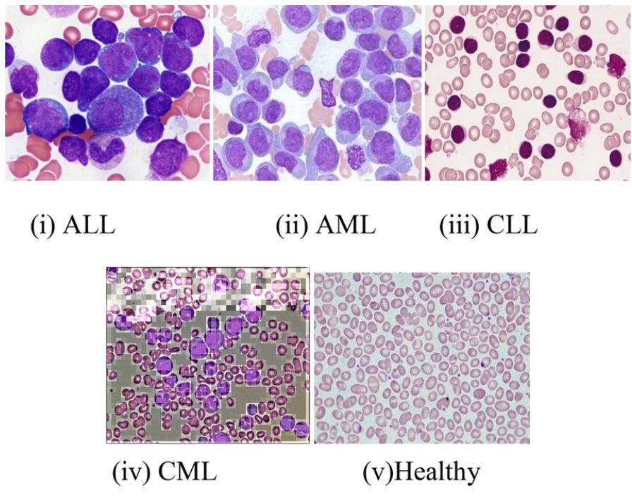 <p>Acute, cuz they are larger and stickier cells</p><p><em>FYI: so you can detect it earlier cuz there are more symptoms&nbsp;</em></p>