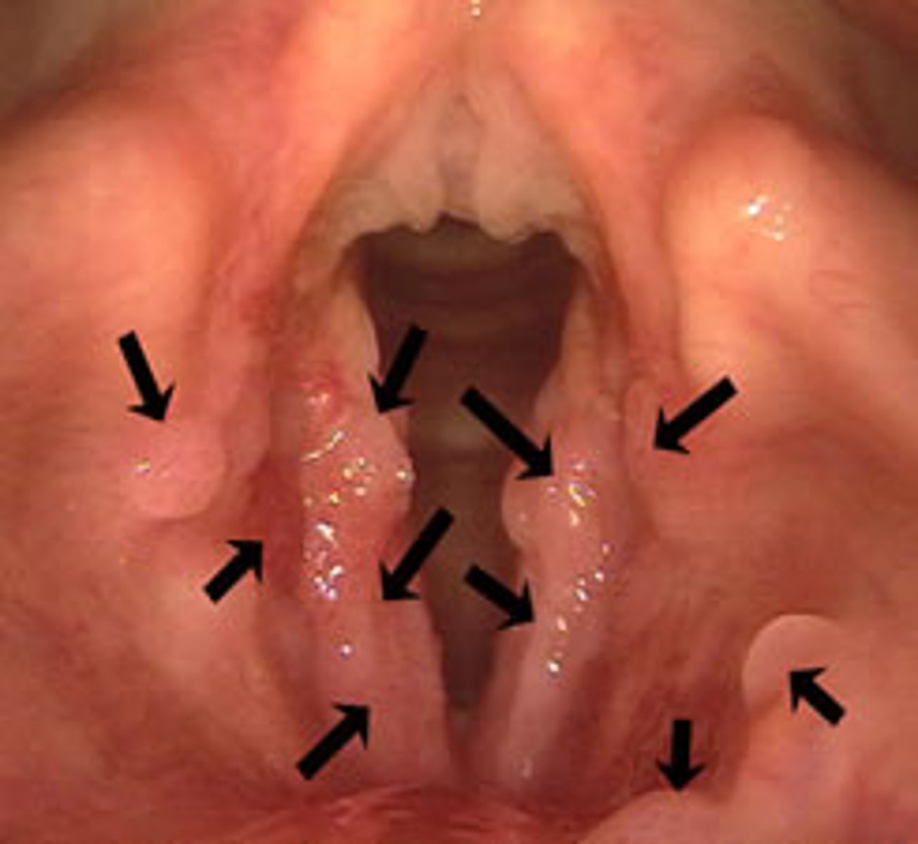 <p>papilloma on the vocal cords, larynx, and respiratory tract that are transmitted from mother to child at birth (HPV 6 and 11)</p>