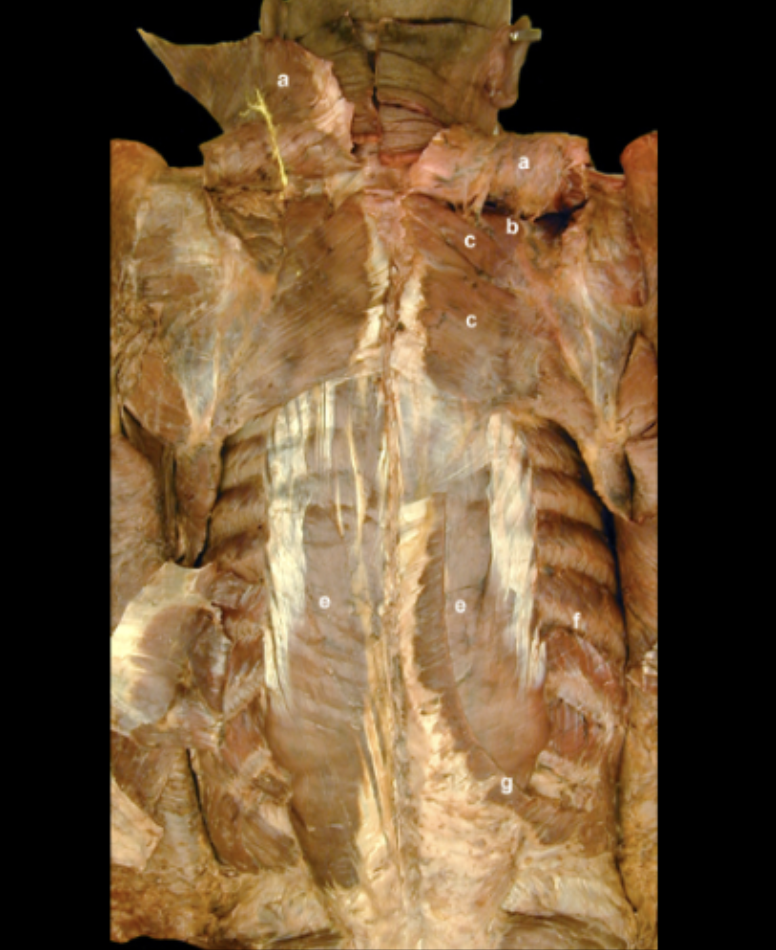 <p>Reflection of the Rhomboid Muscles</p>
