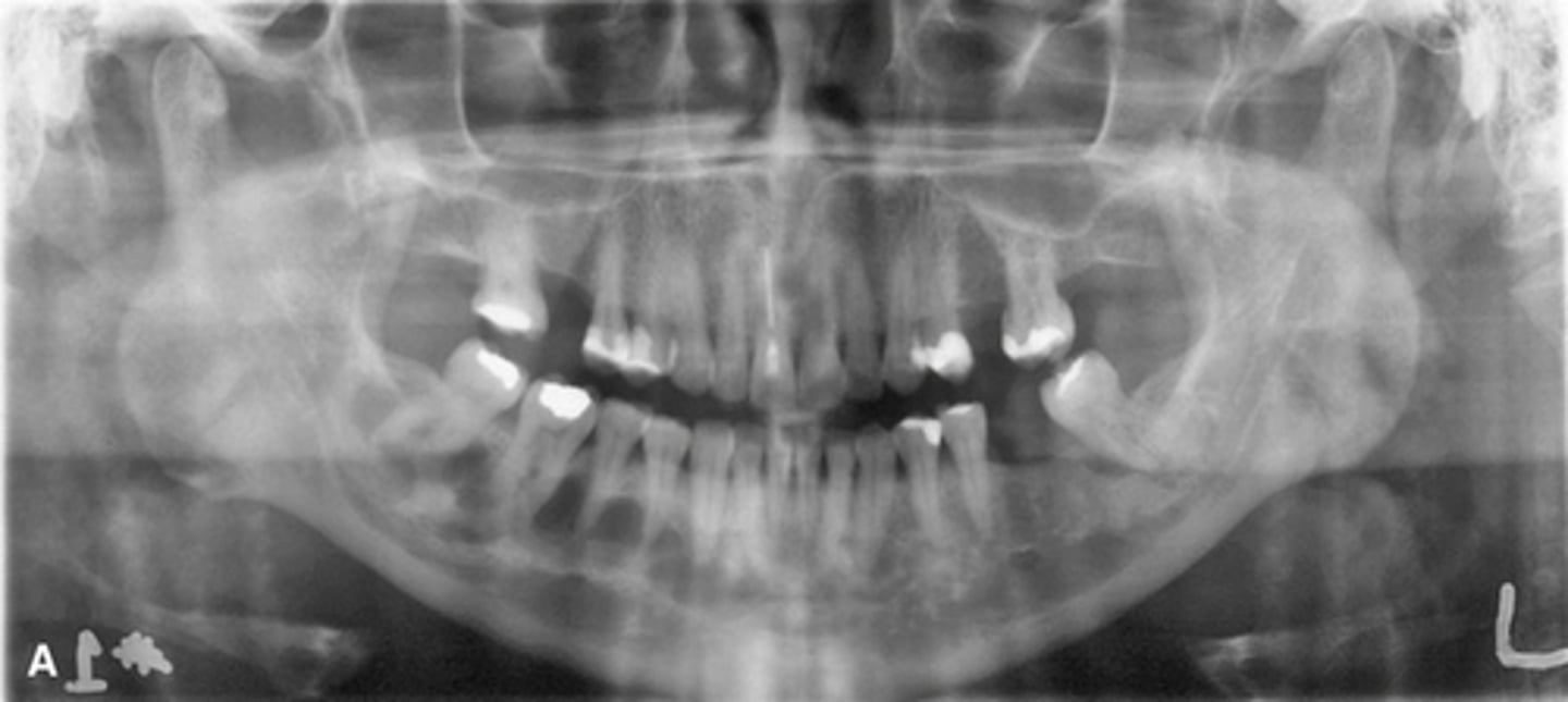 <p>________ is commonly associated with this dysplasia pictured.</p>