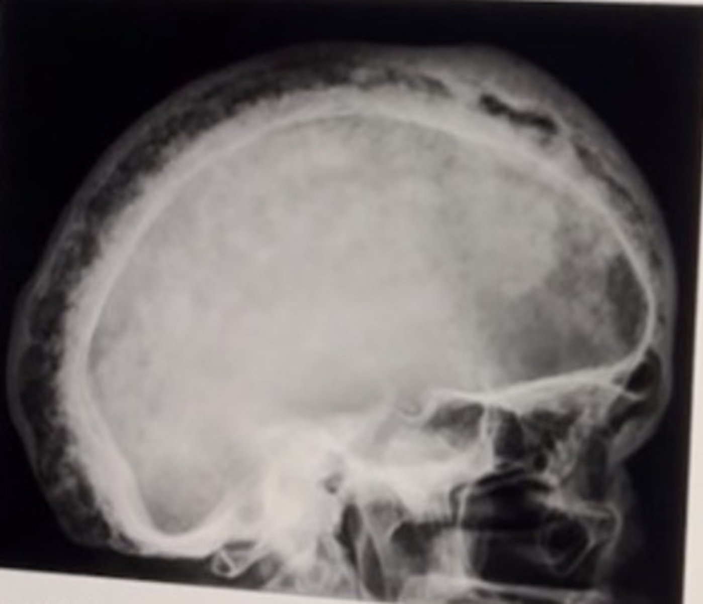 <p>76 year old male</p><p>Please choose the diagnosis and most clinically significant finding.</p>