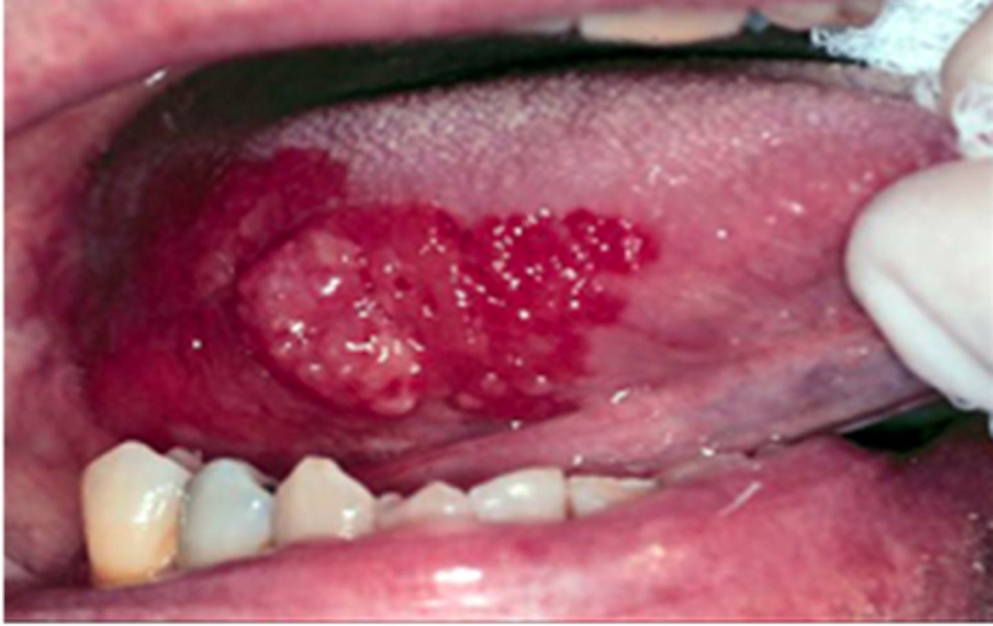 <p>-Related to hyperkeratosis related to chronic irritation</p><p>-Most often associated with <strong>tobacco &amp; alcohol use</strong></p><p>-90% transform into malignancy</p><p>-MC in older pts</p><p>-CX: "Fiery" red, well demarcated lesions of mucosa; may be flat/depressed; smooth or granular</p><p>-DX: Biopsy</p><p>-TX: excision with clear margins</p>