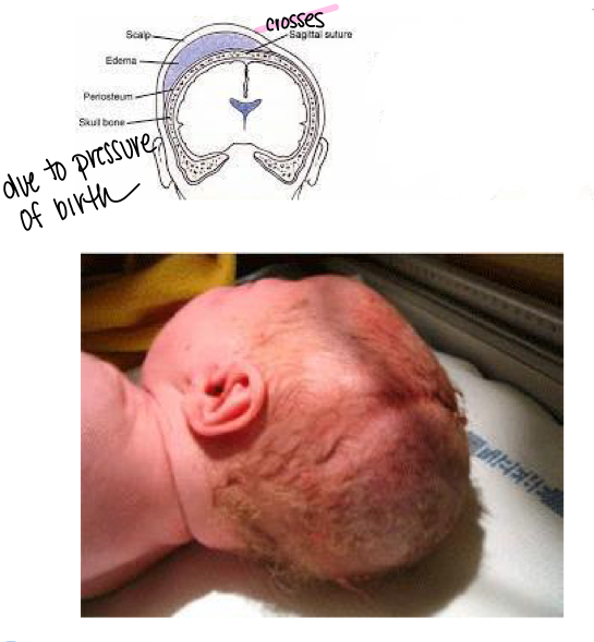 <p>Edema in scalp</p>