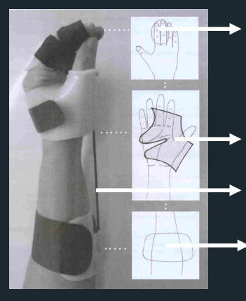 <p>Tenodesis Training Splint - Parts </p>
