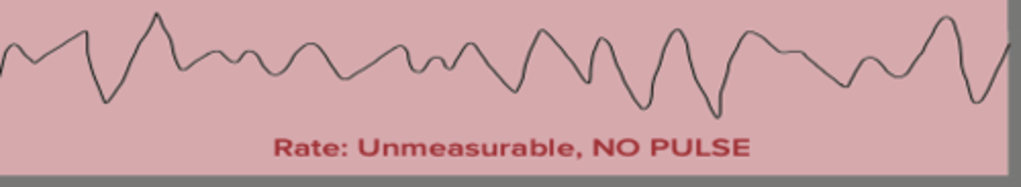 <p>- uncoordinated contraction of the ventricles</p><p>- no discernable rate or rhythm</p><p>- ALWAYS pulseless</p><p>- quivering, squiggles</p>