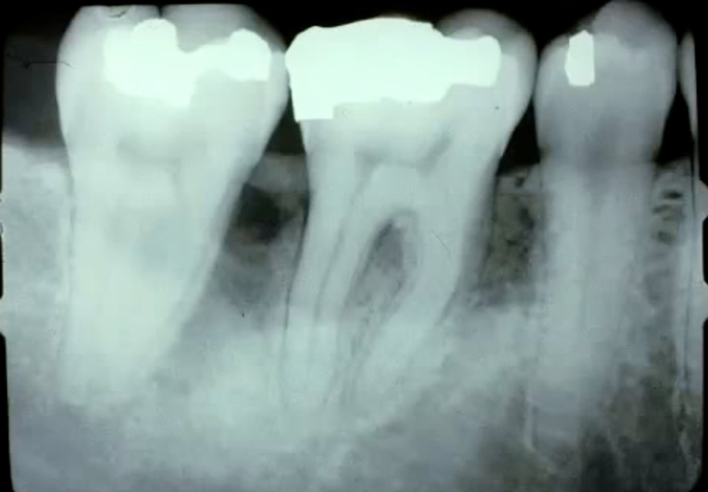 <p>triangular/semicircular radiolucency on lateral and cervical portion of the root</p><p>may resemble vertical bone loss </p>