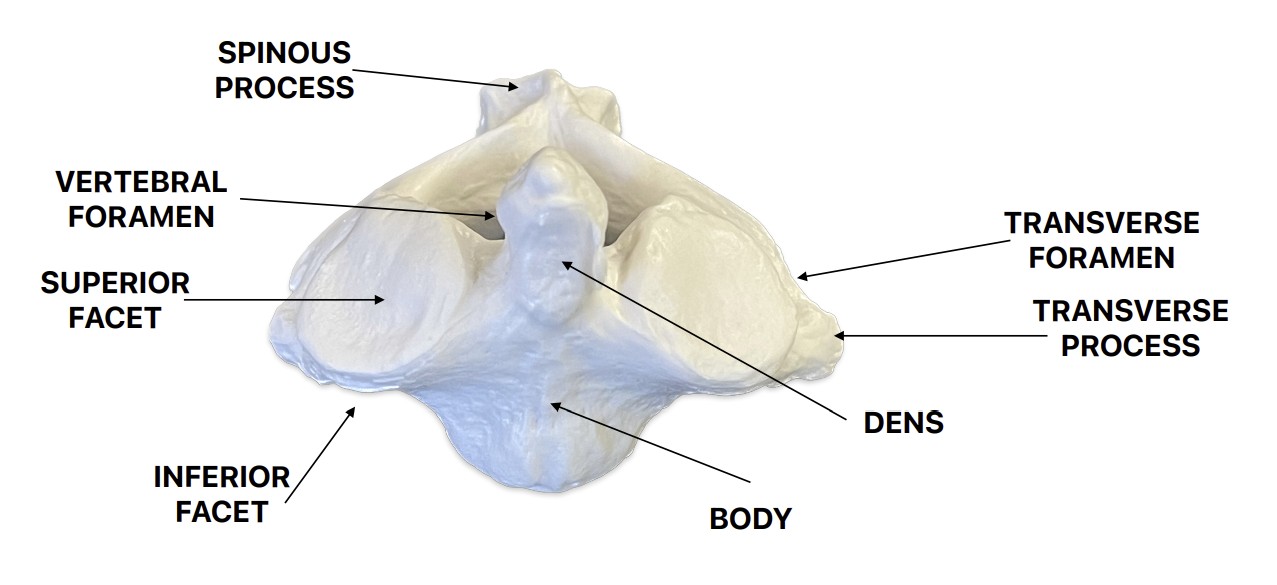 <p>What are these landmarks of:</p><ul><li><p>Transverse foramen - hole of wing tip</p></li><li><p>Transverse process - wing tip</p></li><li><p>Vertebral body - main body</p></li><li><p><span style="color: yellow;"><strong>Dens - stick up</strong></span></p></li><li><p>Spinous process - bumps on posterior side</p></li><li><p>Vertebral foramen - big hole</p></li><li><p>Superior &amp; Inferior facets - circular concave surface on top and bottom</p></li></ul><p></p>