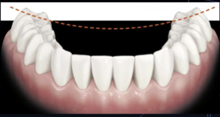 <p>mediolateral curvature of the occlusal plane of posterior teeth</p>