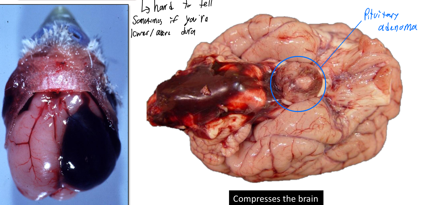 <ul><li><p>Blood accumulation beneath/above the dura</p></li></ul><p></p>