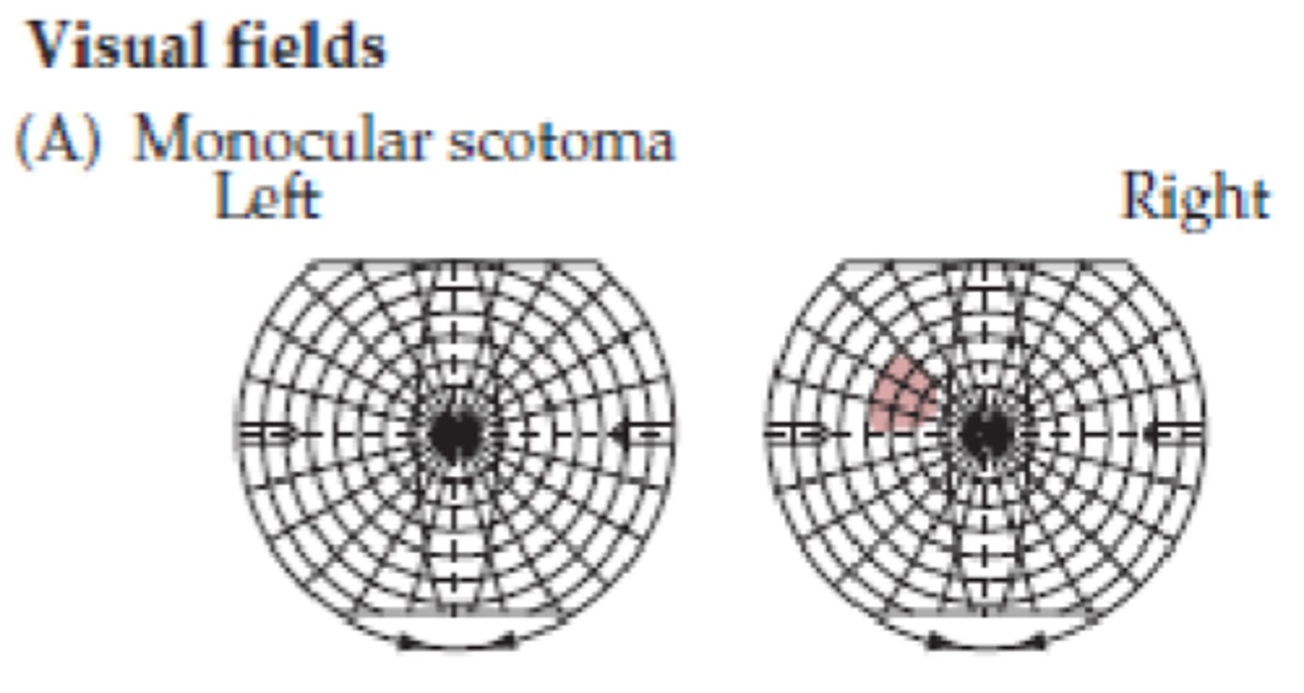 <p>Monocular scotoma</p>