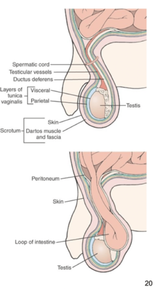 <p>some males still have an opening were testes descended from the abdominal cavity, which makes these males more prone to inguinal hernias</p>