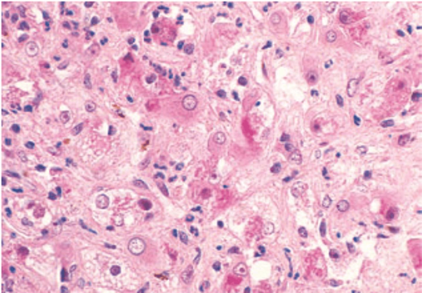 <p>A 49-year-old woman presents with a 1-month history of yellow discoloration of her eyes, abdominal pain, malaise, weight loss, and low-grade fever (38.4°C, 101°F). Physical examination shows a distended abdomen with right upper quadrant tenderness and a palpable liver 2 cm below the right costal margin. Laboratory studies reveal decreased serum albumin (2.6 g/dL), elevated serum AST (225 U/L) and ALT (150 U/L), and increased alkaline phosphatase (210 U/L). The prothrombin time is prolonged (15 seconds). A moderate leukocytosis (13,500/μL, 80% neutrophils) is observed. A liver biopsy is shown in the image. These pathologic ﬁndings are most commonly associated with which of the following liver diseases?</p><p>(A) Alcoholic hepatitis</p><p>(B) Chronic hepatitis B</p><p>(C) Chronic hepatitis C</p><p>(D) Hemochromatosis</p><p>(E) Primary biliary cirrhosis</p>