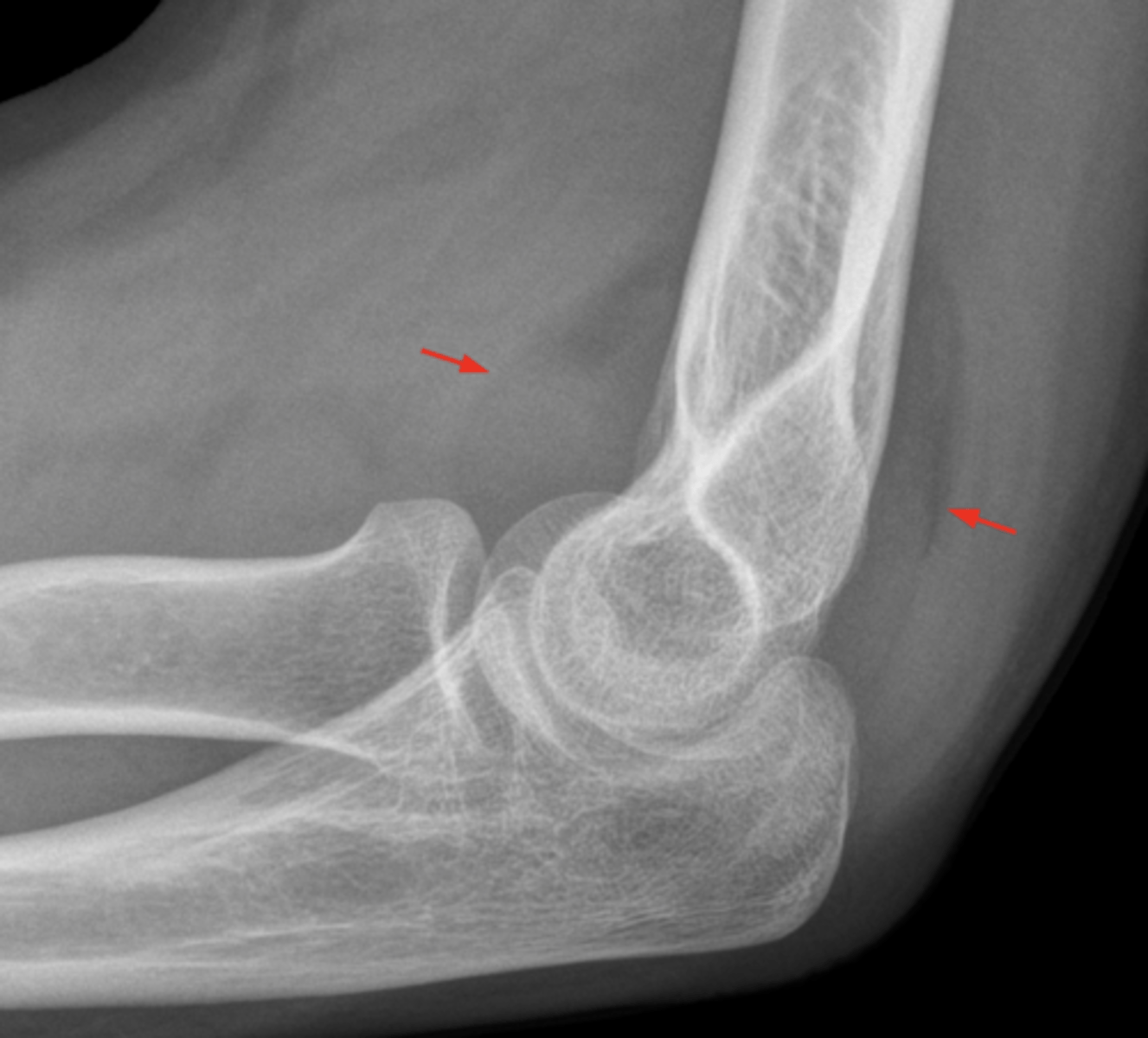 <p>The fossae of the elbow contain synovial joint fluid and fat pads.</p>