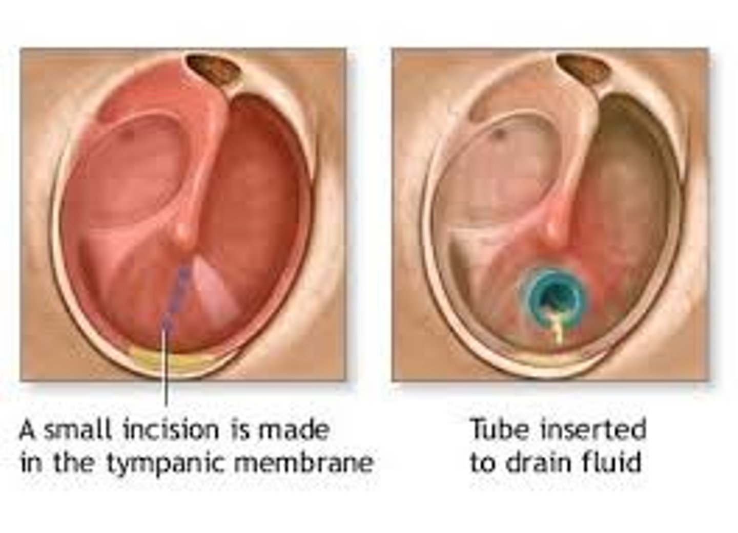 <p>A surgical procedure that involves making a small incision or cut in the tympanic membrane usually to drain fluid from the middle ear space. A myringotomy is performed before insertion of tympanostomy tubes into the tympanic membrane.</p>