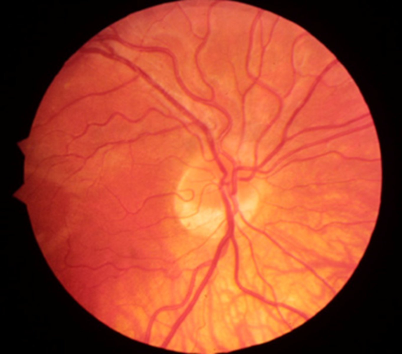 <p>pale colour bc the sclera is showing through</p><p>red colour bc the small disc is in high contrast to the surround</p>