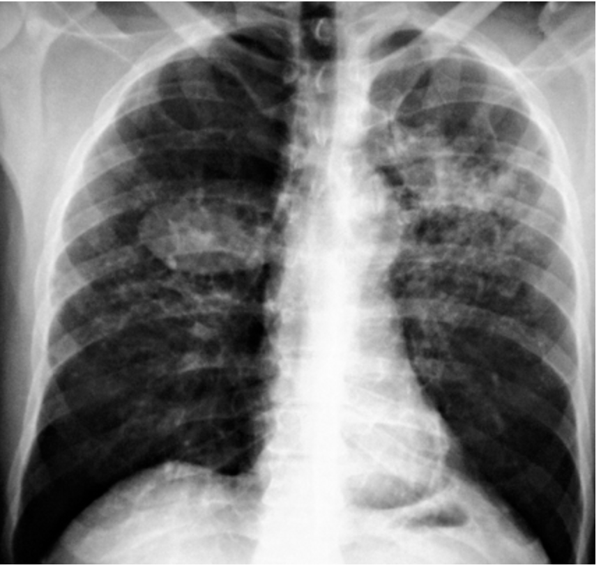 <p>What form of silicosis has large conglomerate densities of nodules in the upper lungs and patients become symptomatic with dyspnea?</p>